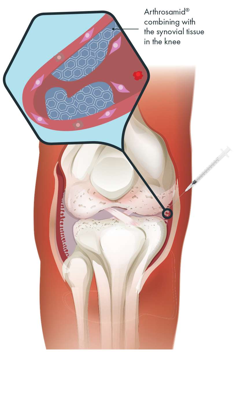 How Arthrosamid works in the knee